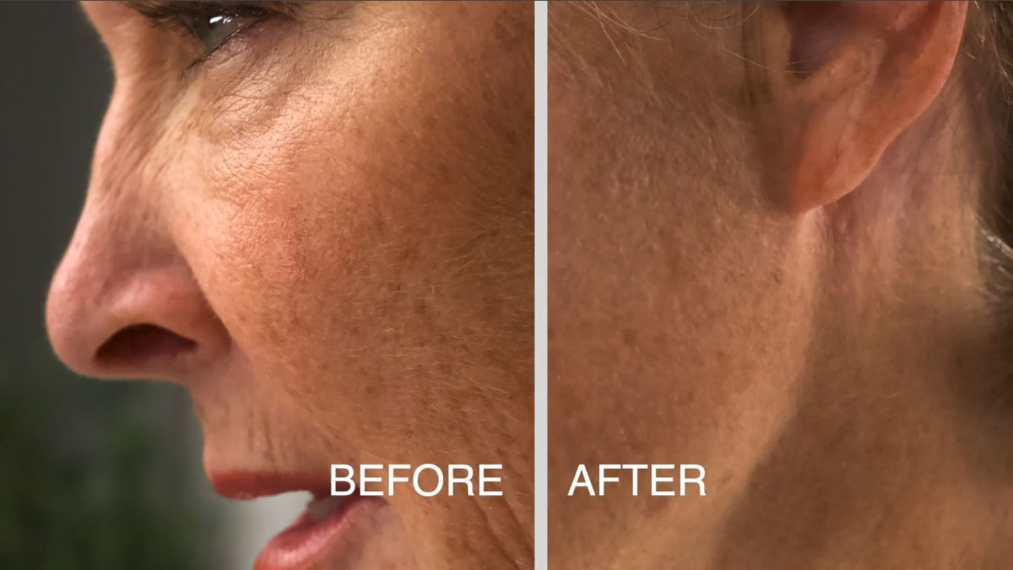 LumaBlade – Exfoliation and Peach Fuzz Hair Removal w/ Red Light Therapy